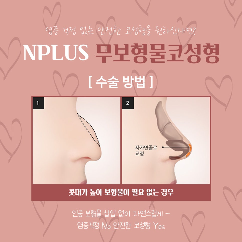 무보형물코수술후기 자연스러운 코라인으로 관련 이미지 7