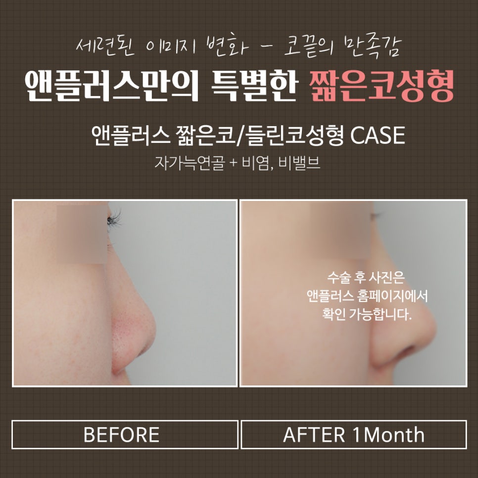 들창코수술후기 튼튼한 비주지지대 관련 이미지 4