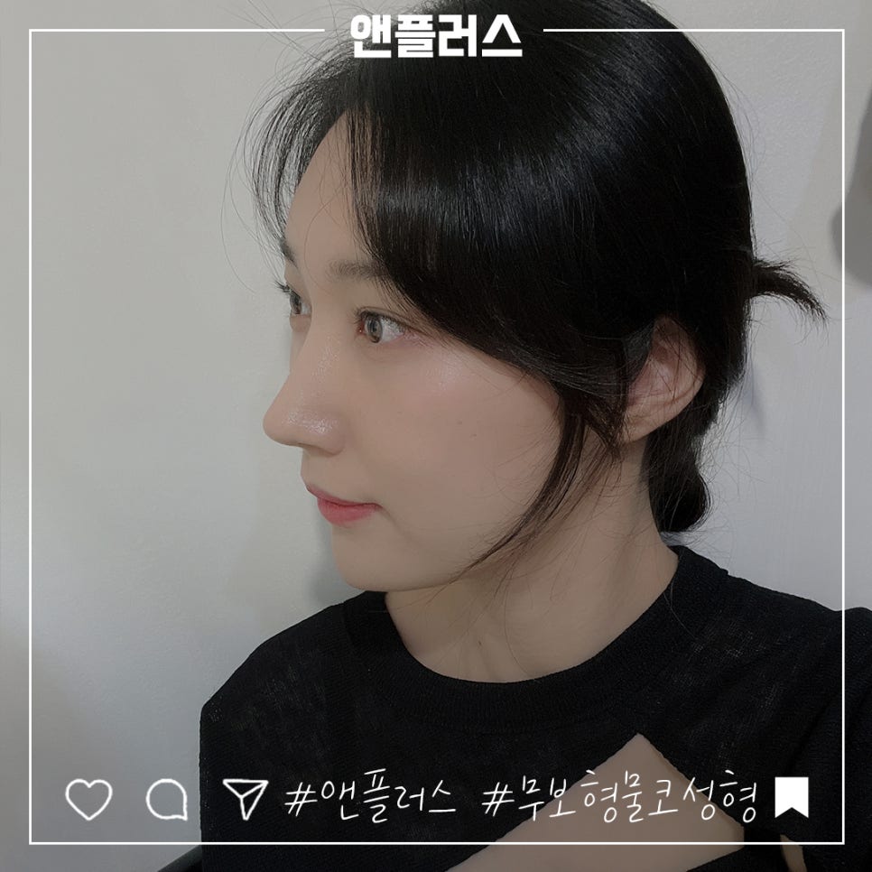 무보형물코수술을 통해 자연스러운 코라인으로 관련 이미지 2