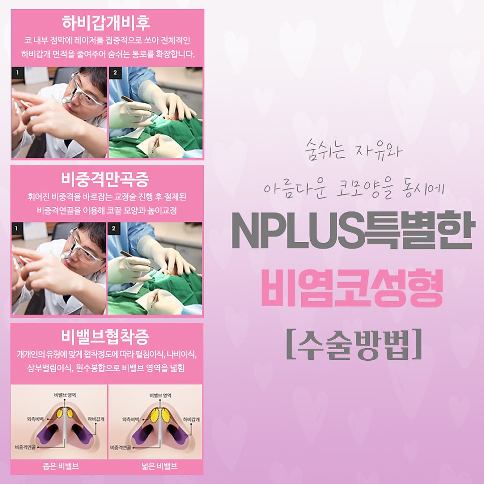 Learn in Detail About Rhinoplasty for Rhinitis image 7