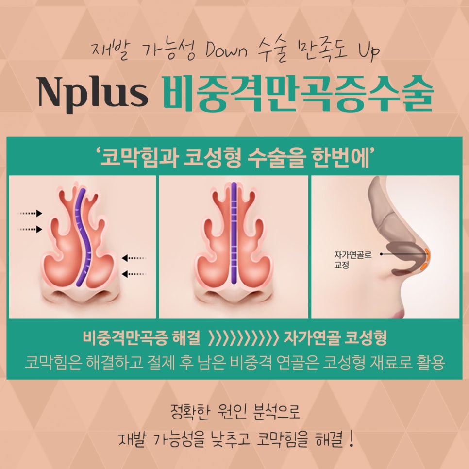 비중격만곡증수술 꼼꼼하게 알아보고 관련 이미지 8