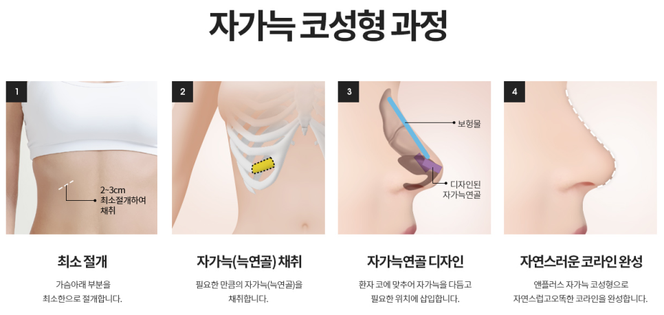 Check Whether a Non-Implant Rhinoplasty Is Possible in Your Case! image 5