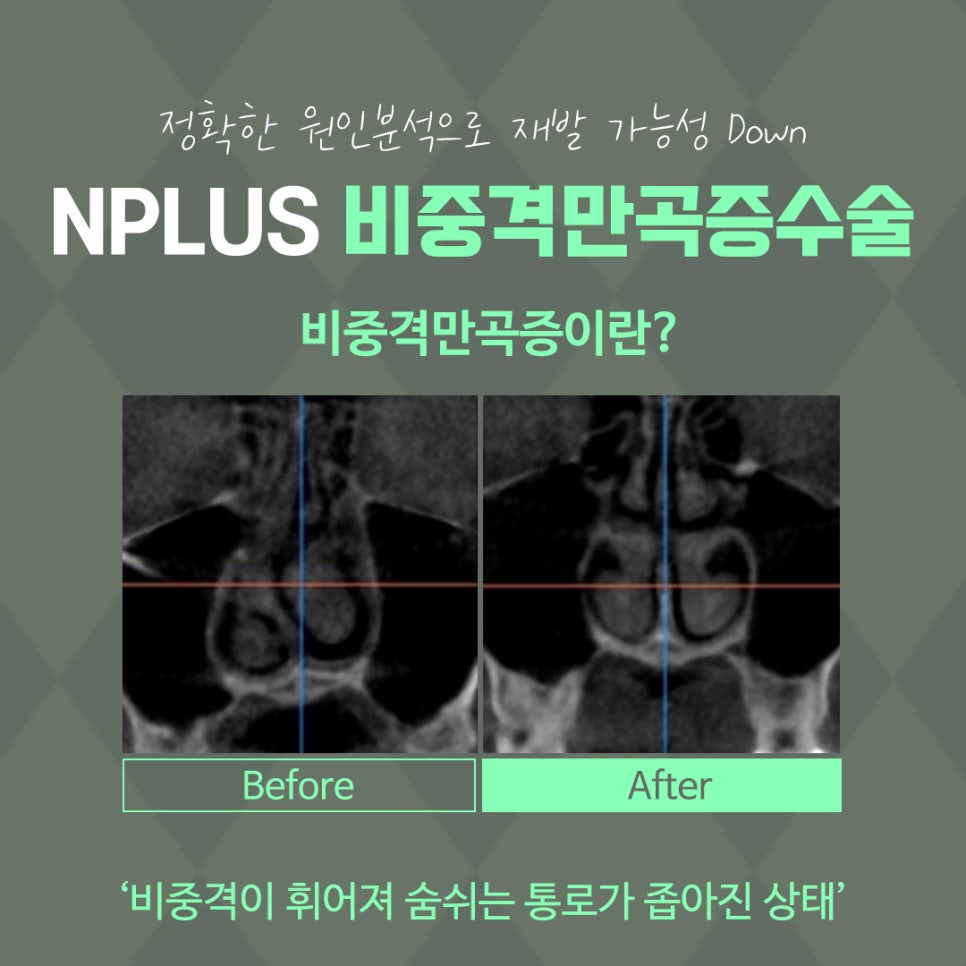 비중격코수술 원인 파악을 확실하게 관련 이미지 6