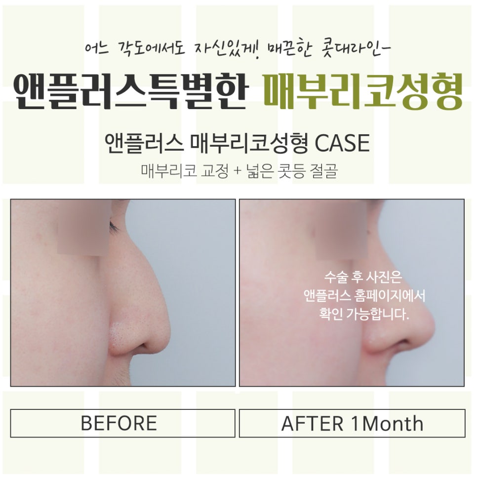 매부리코성형후기 정확한 진단을 통해 관련 이미지 14