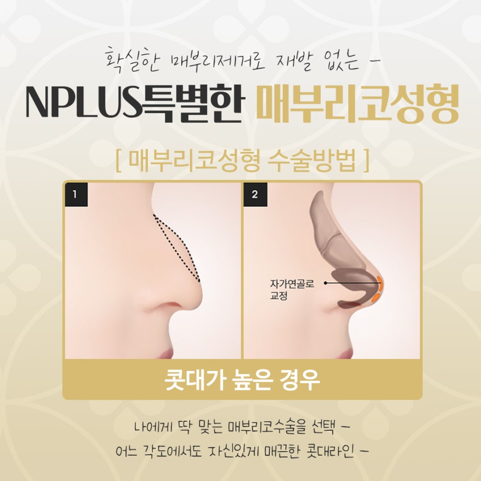 매부리코수술후기 확실하게 확인하여 관련 이미지 8