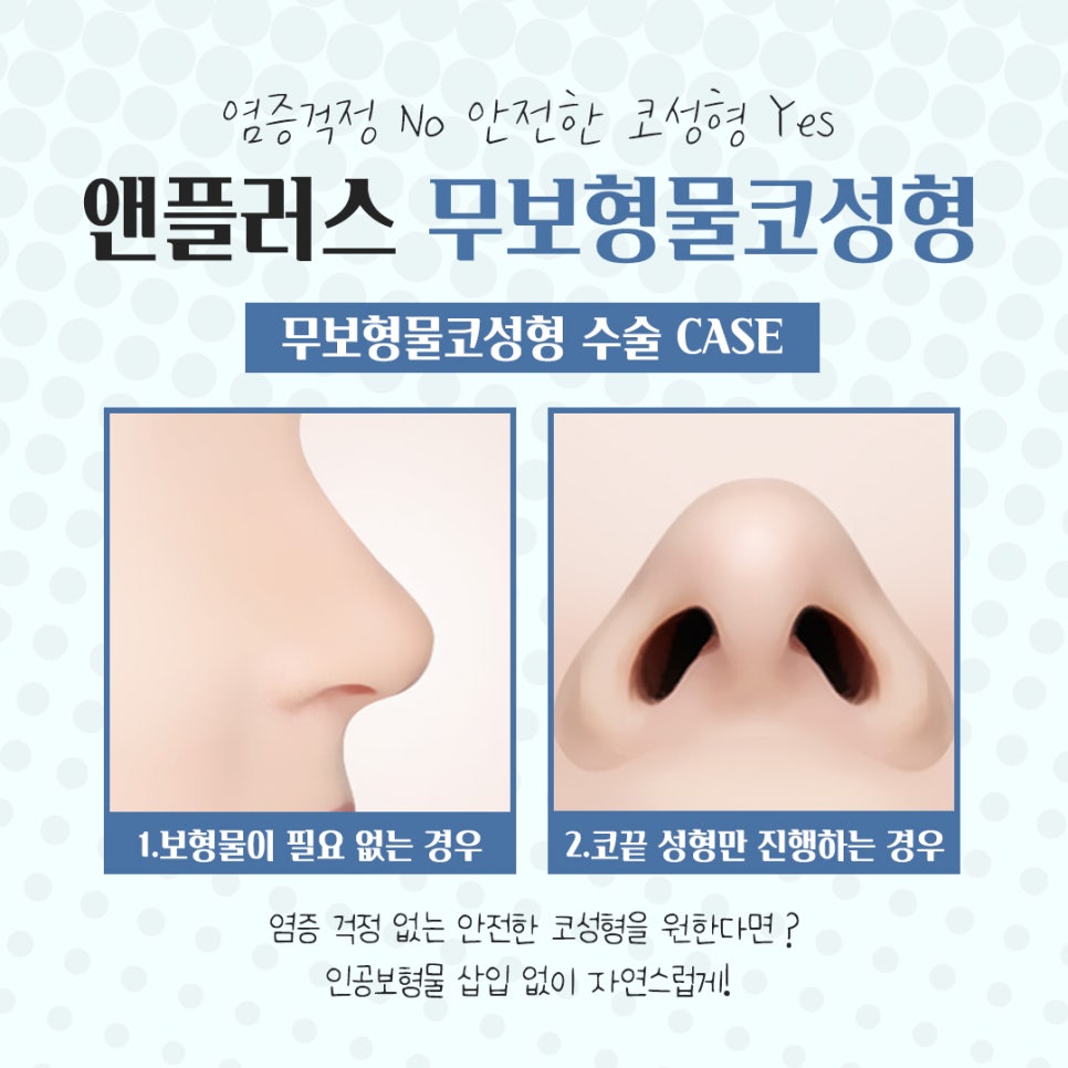 무보형물코수술을 통해 자연스러운 코라인으로 관련 이미지 6