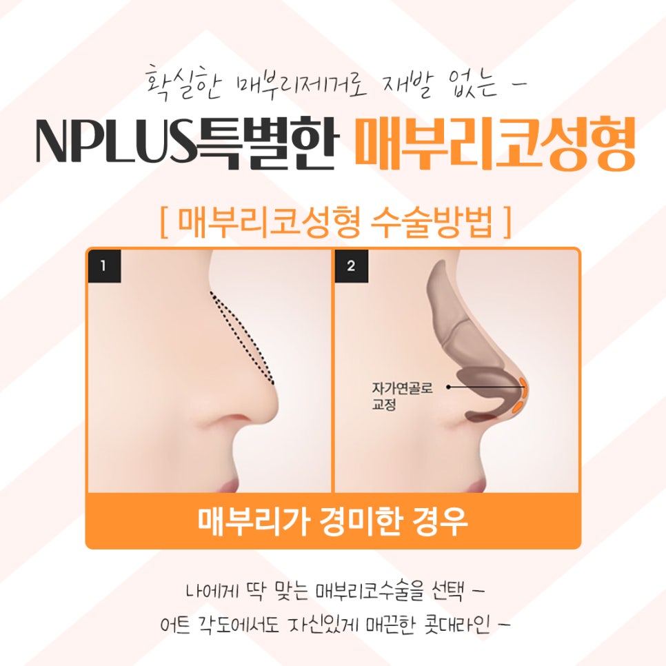 Hump Nose Surgery Review with a Clear Diagnosis image 11