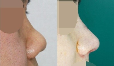 복코교정(낮은코) + 들린 코끝성형 관련 이미지 1