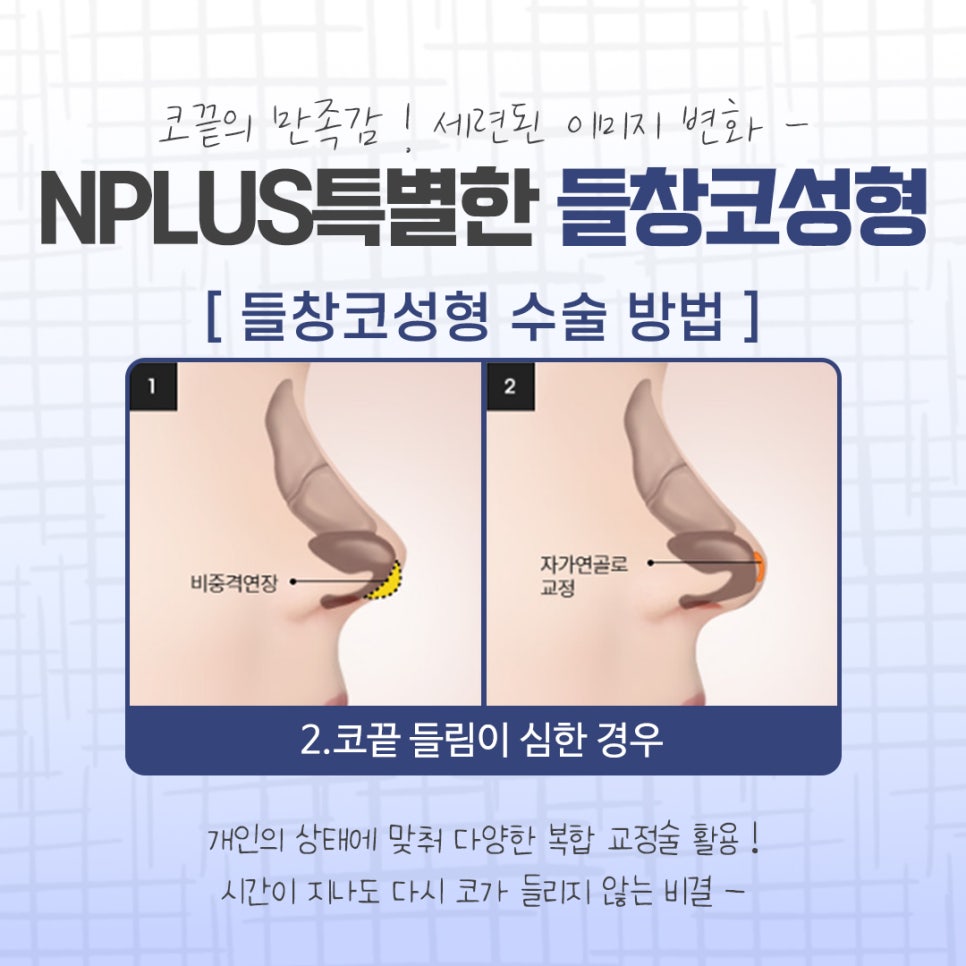 들창코성형 후기를 비교해 보고 관련 이미지 9