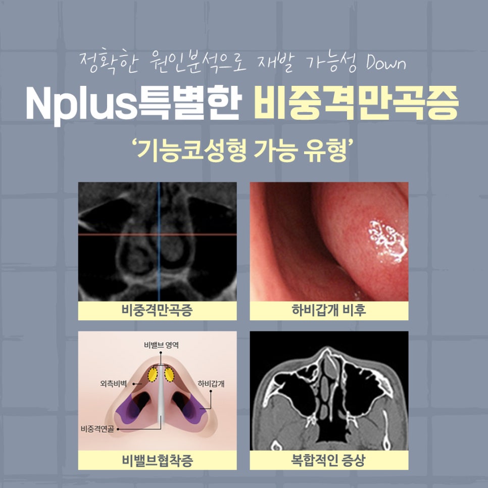 비중격만곡증수술 후기까지 확인하여 관련 이미지 5