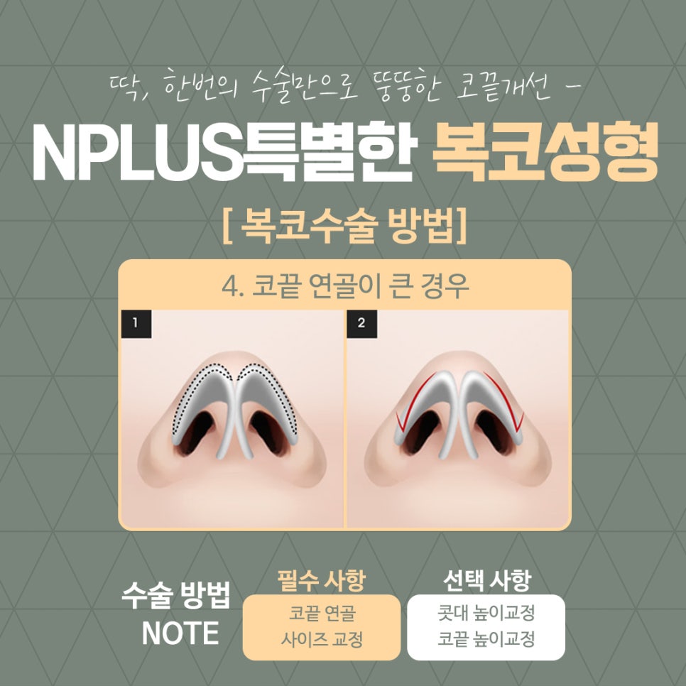 복코성형으로 세련된 이미지 변신 관련 이미지 12