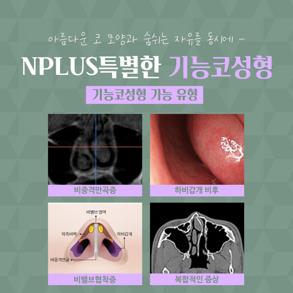 코수술후기 라인까지 고려해서 관련 이미지 9