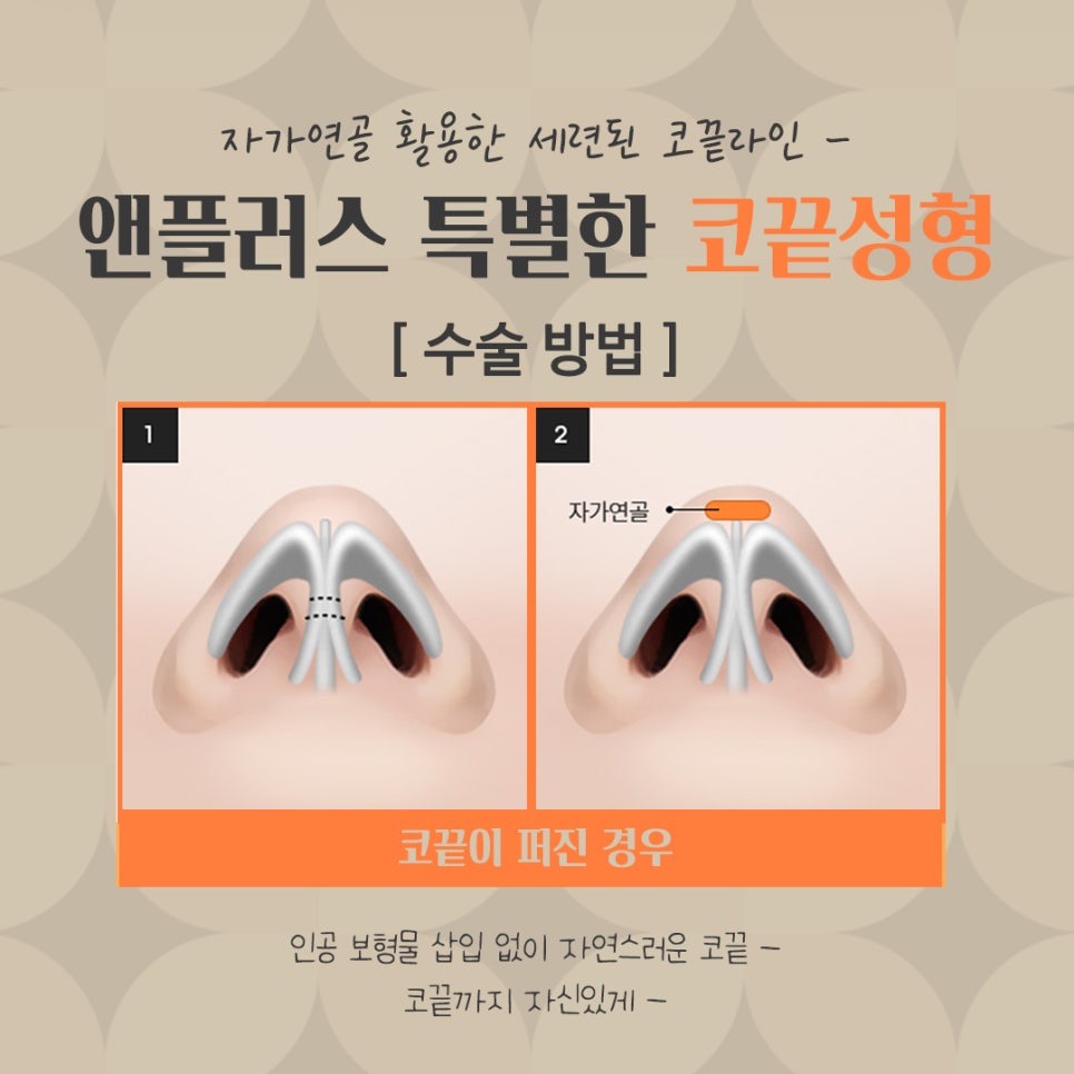 코끝수술후기 자가연골로 안전하게 관련 이미지 9