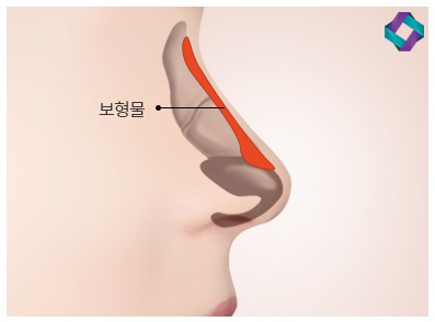늑연골 코성형 : 자가연골의 장점과 단점 (자가연골 비교) 관련 이미지 2