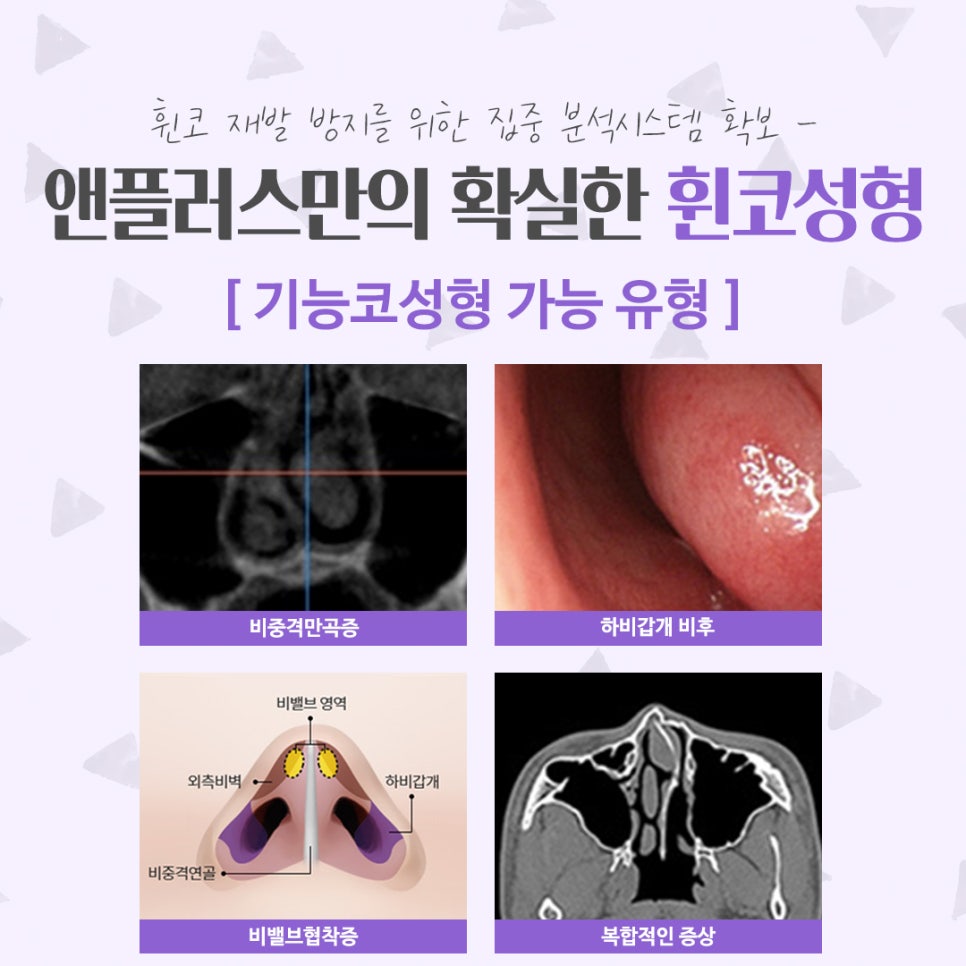 Bent Nose Surgery Review: With an Accurate Diagnosis image 6