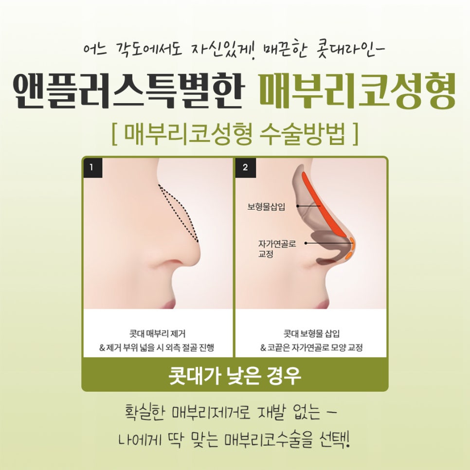 매부리코수술후기 다양한 이미지를 확인하고 관련 이미지 9