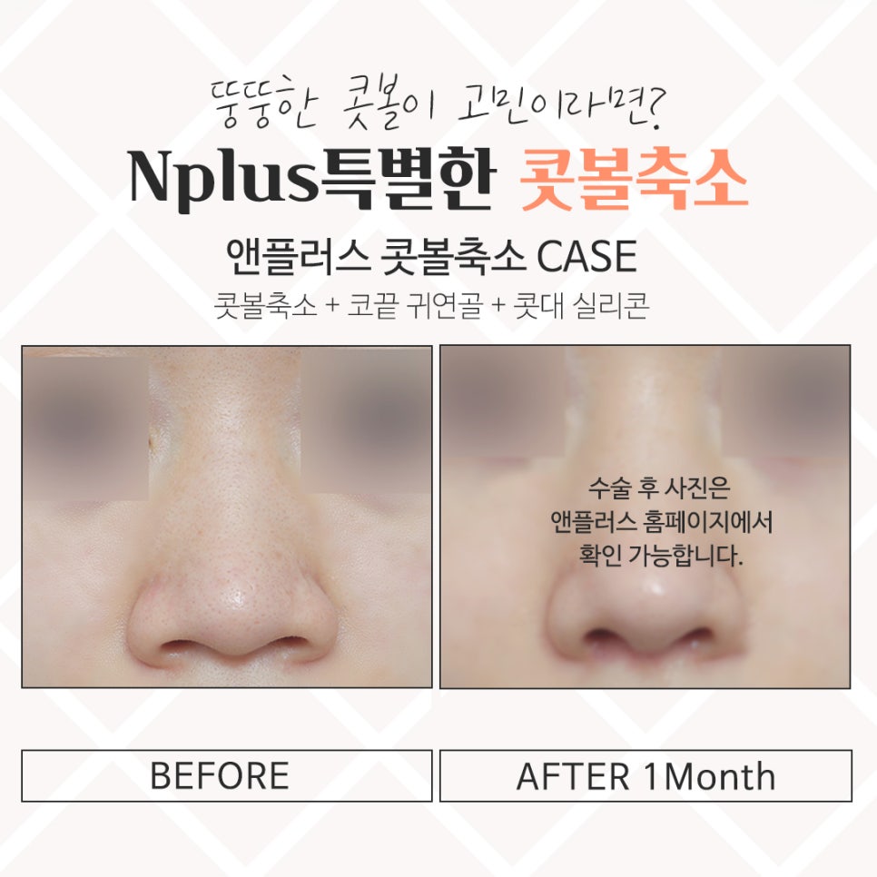Looking Closely at Nostril Reduction Reviews image 13
