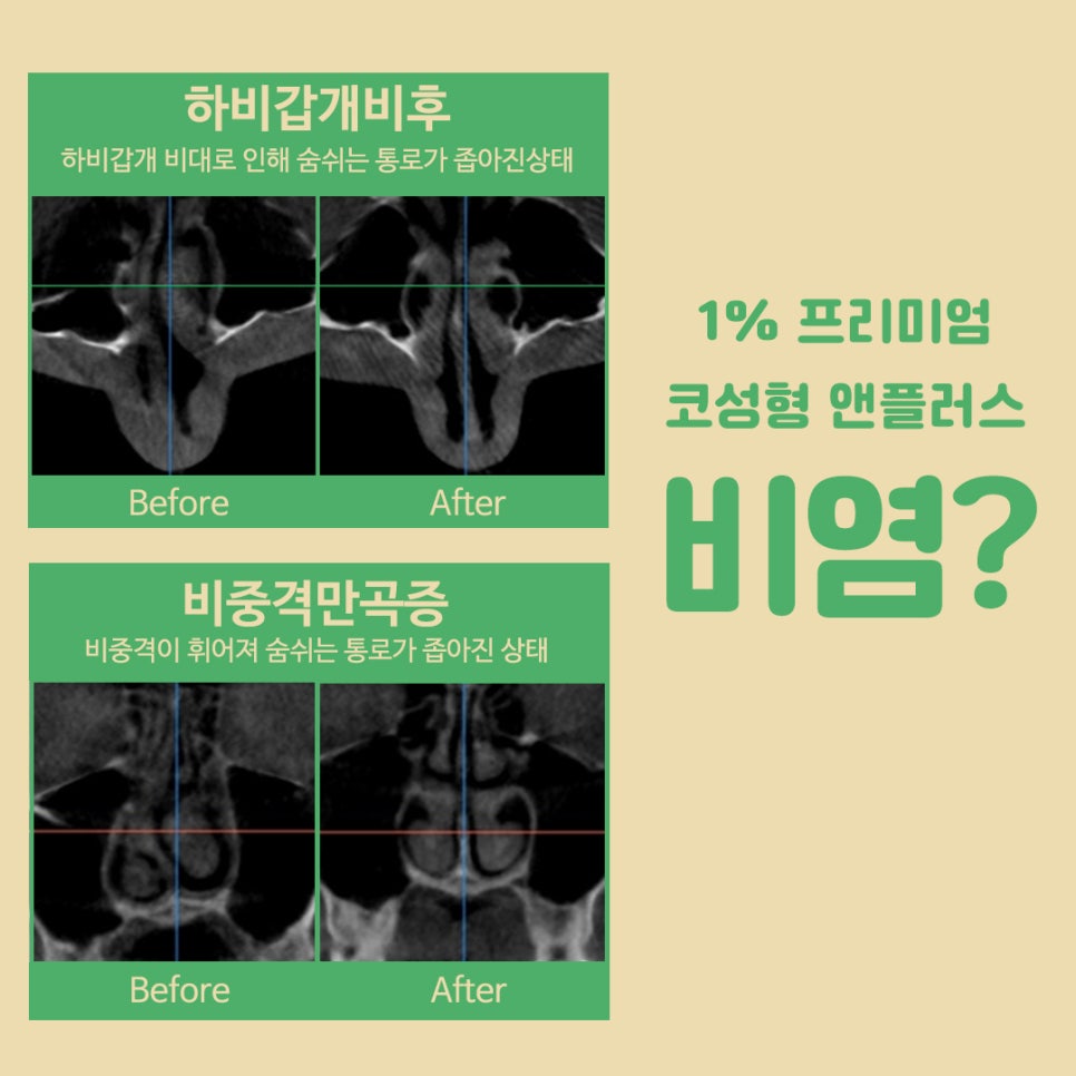 비염수술코성형 동시에 개선이 가능 관련 이미지 2