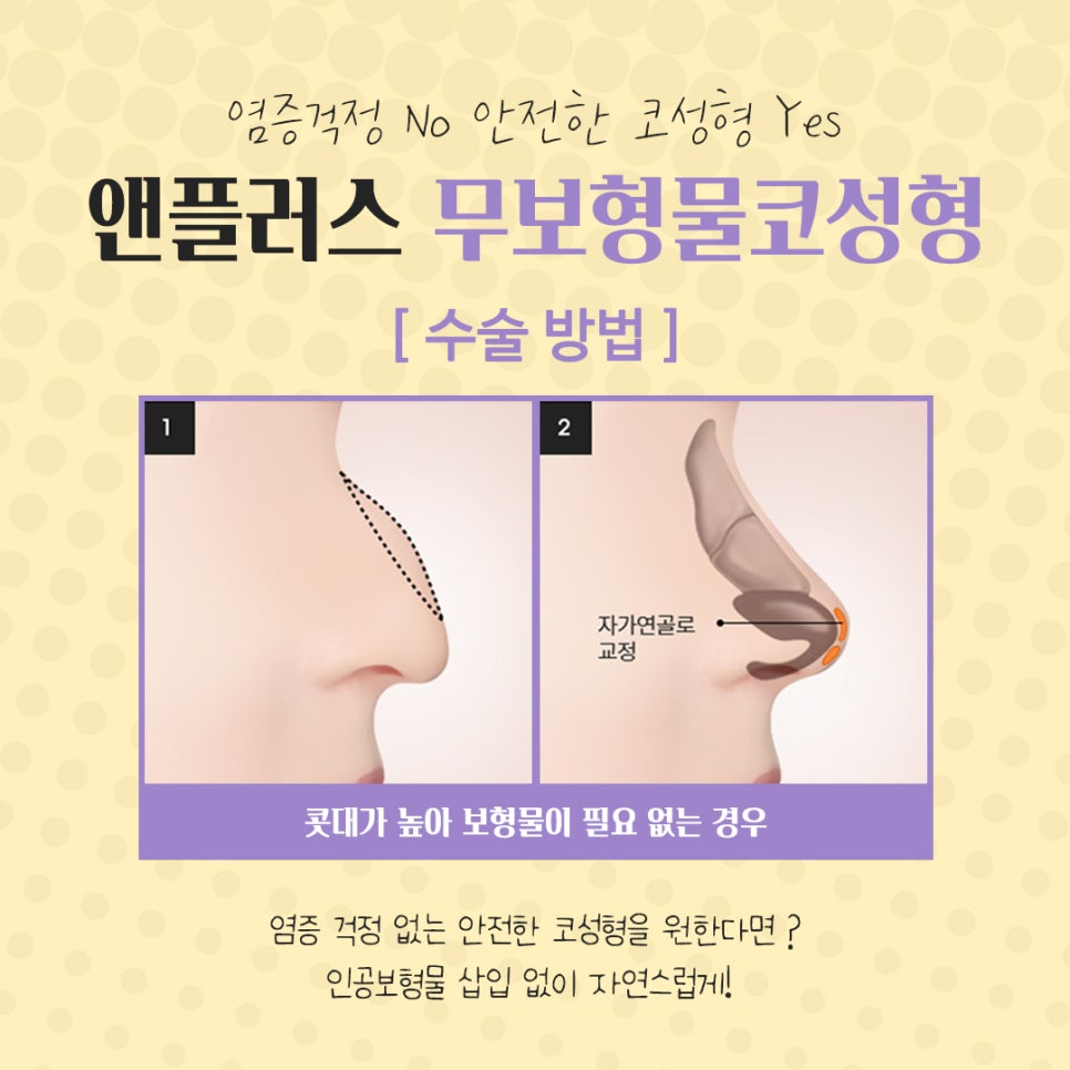 The Importance of Choosing Implant-Free Rhinoplasty image 8