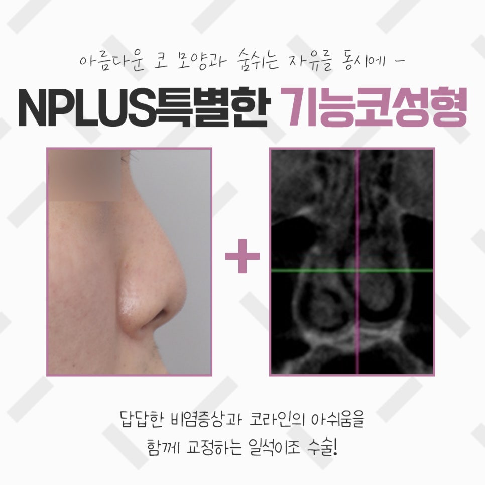 코성형실비를 알아보고 결정 관련 이미지 2