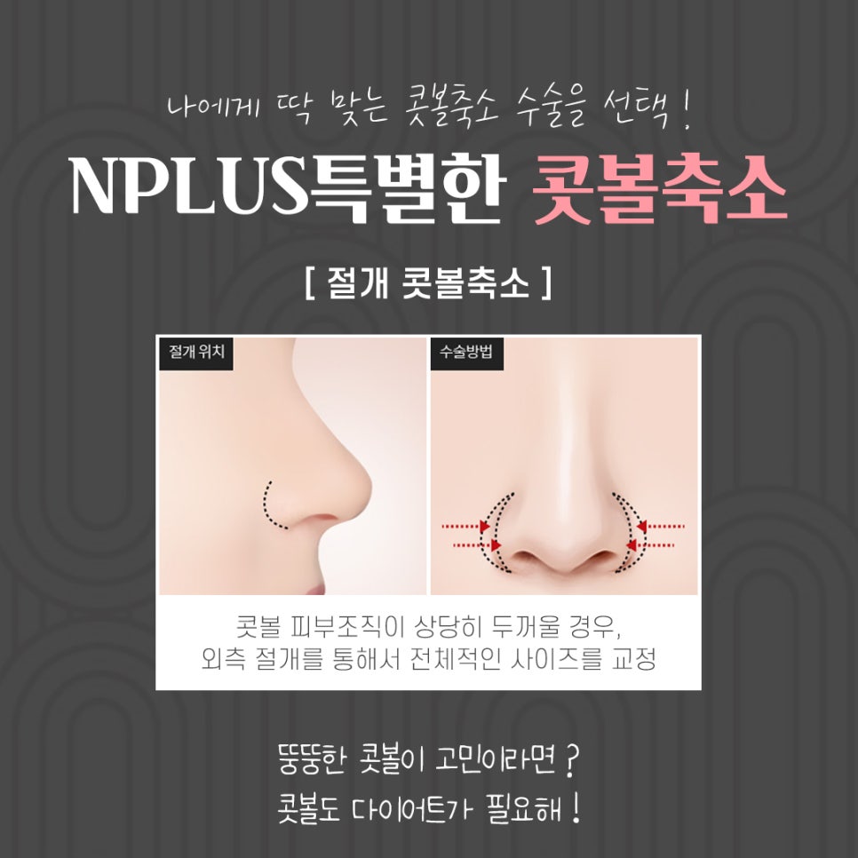 콧볼축소후기 확실하게 알아보고 관련 이미지 7