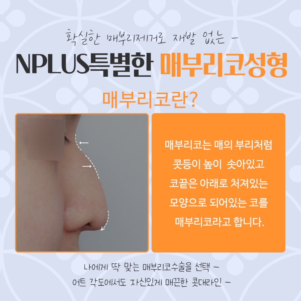 매부리코성형후기 매부리코 잘하는 곳에서 관련 이미지 4
