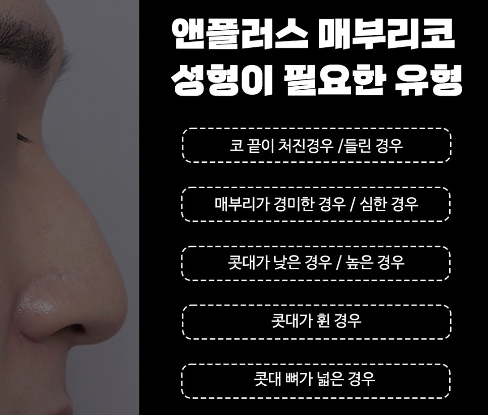 매부리코수술후기_완벽한 매부리제거로 깔끔하게 관련 이미지 2