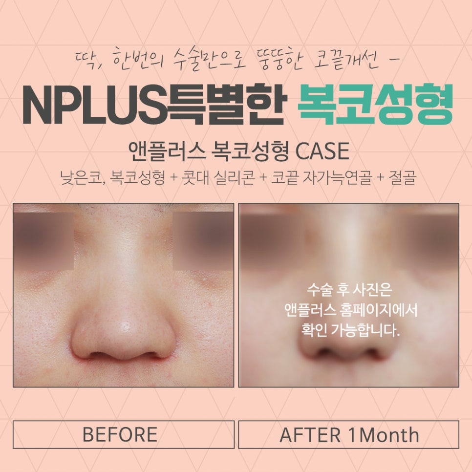 복코성형후기 코지방제거로 확실하게 관련 이미지 14