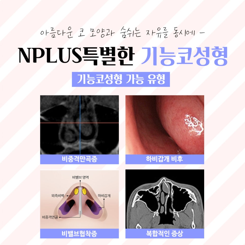 코수술후기에 대해 정확하게 진단하여 관련 이미지 4
