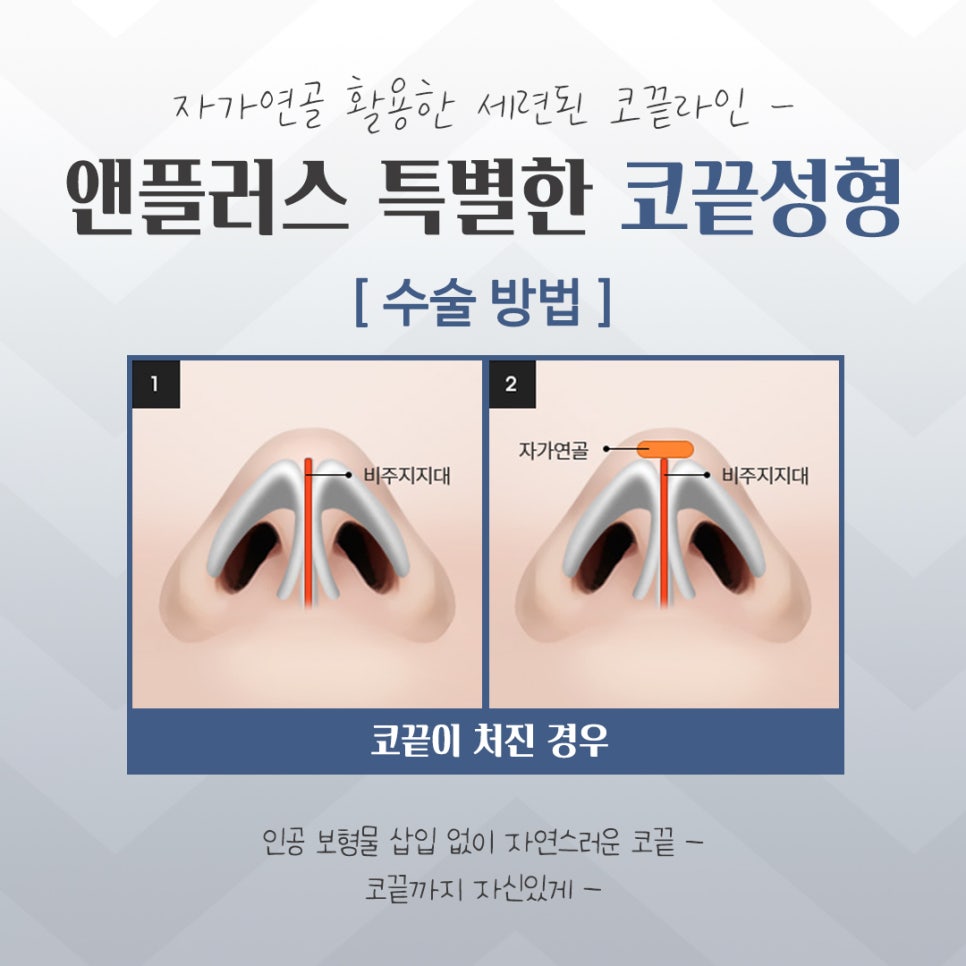 코끝수술후기에 대한 내용을 알아보고 관련 이미지 9