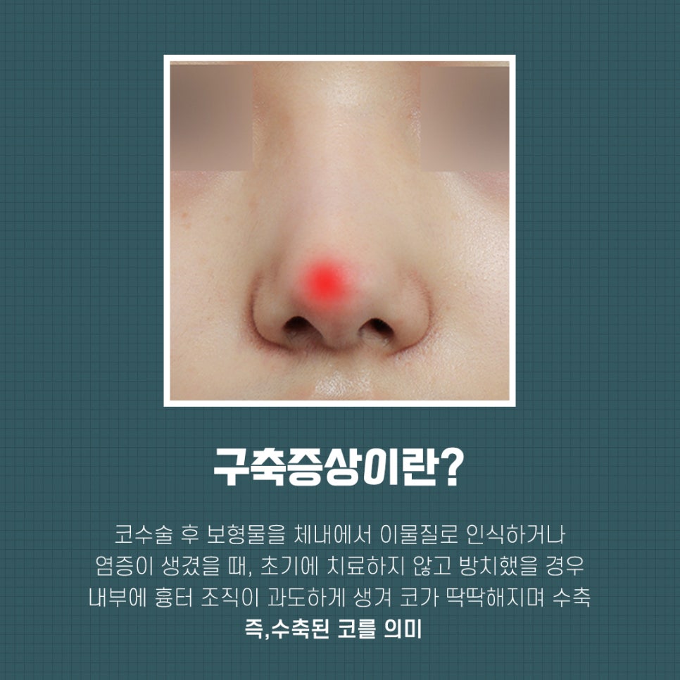 Revision Rhinoplasty Review: A Choice You Won’t Regret image 6