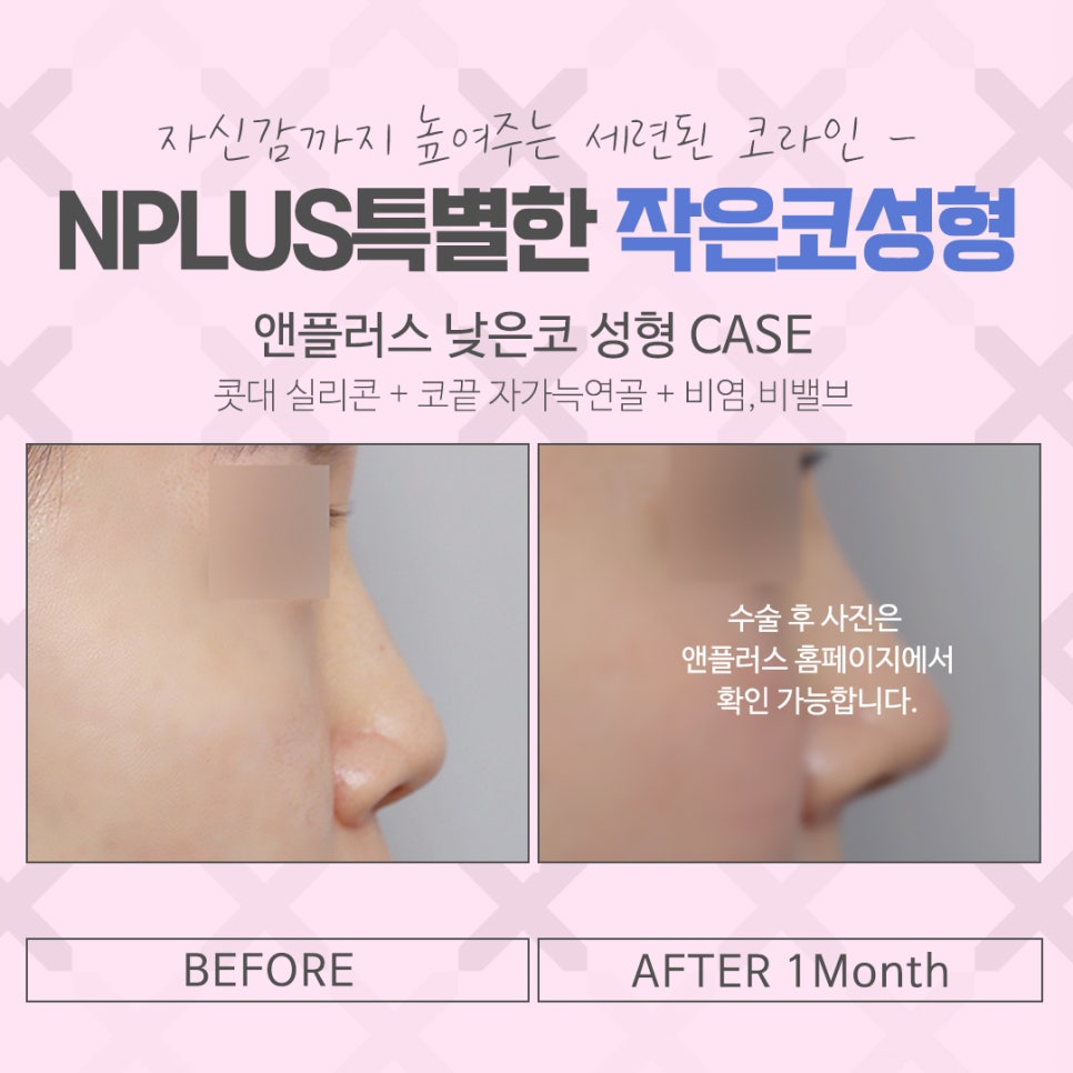 Carefully Reviewing Small Nose Surgery Reviews image 12
