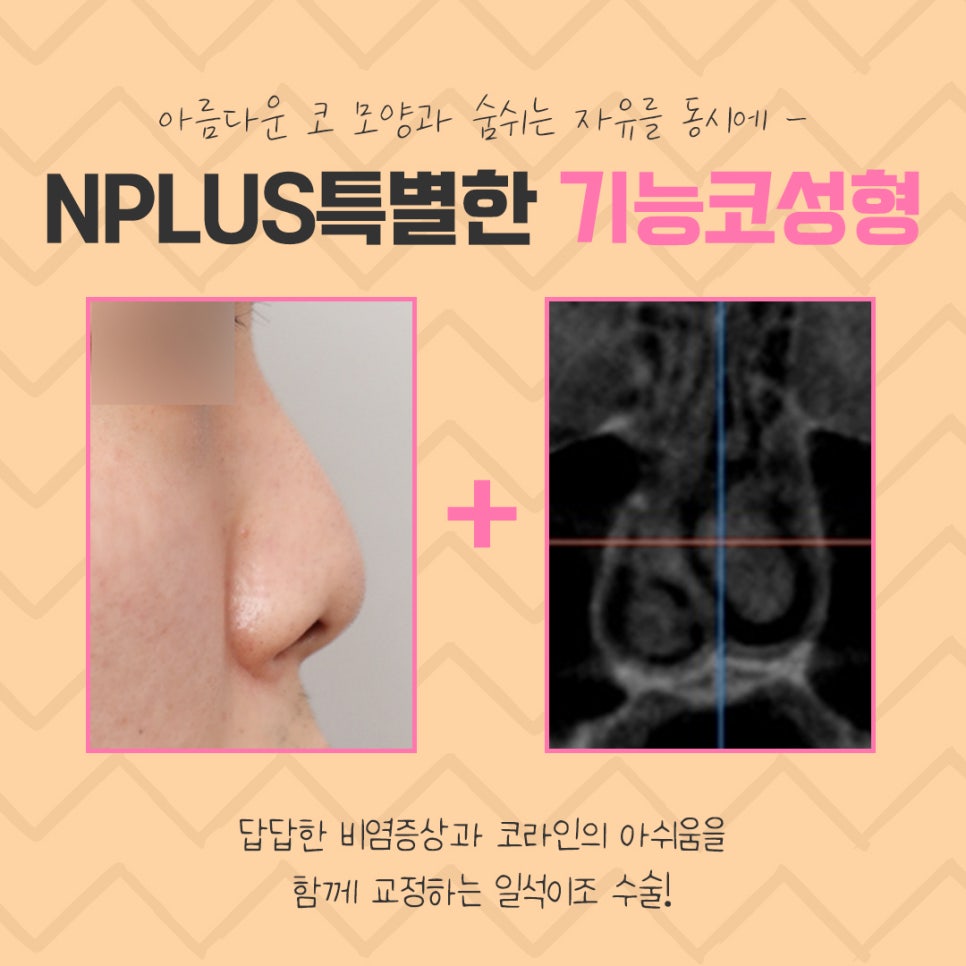 Functional Nose Surgery Reviews with Improved Nasal Line image 3