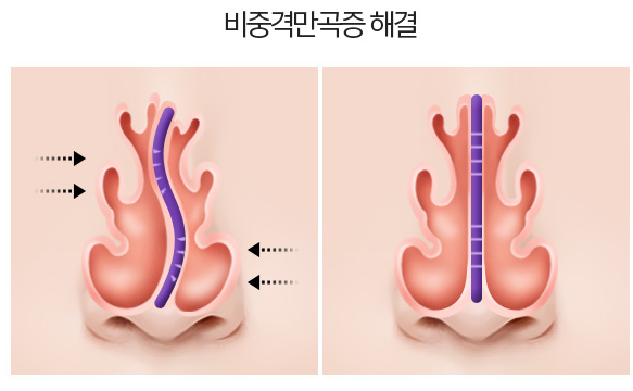 Be sure to research rhinoplasty for rhinitis before surgery! image 5