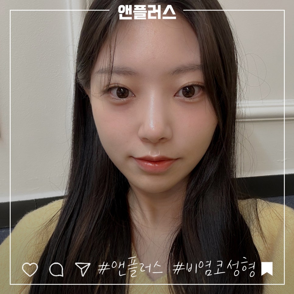 앤플러스에서 진행된 비염수술코성형에 대하여 관련 이미지 1