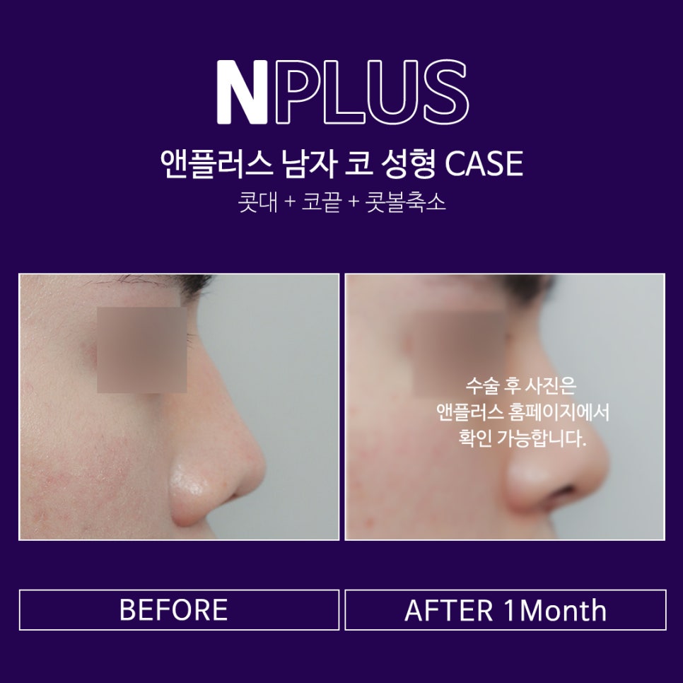 오지코성형외과_남자성형전후 만족스러운 결과 관련 이미지 5