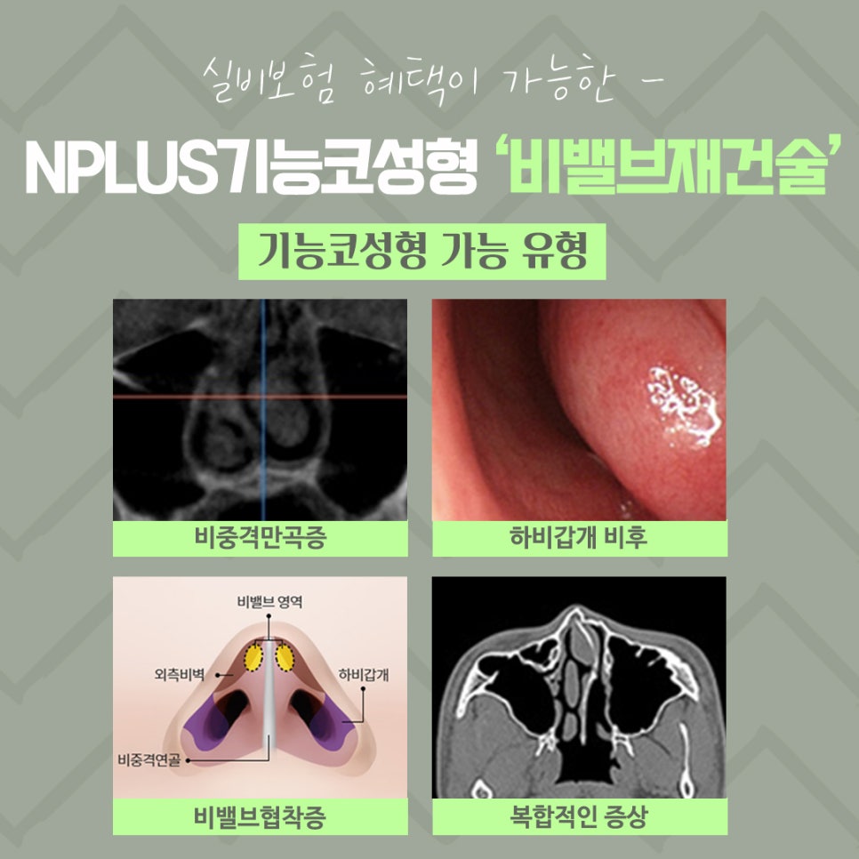 비밸브재건술을 통한 숨 쉬는 자유 관련 이미지 4