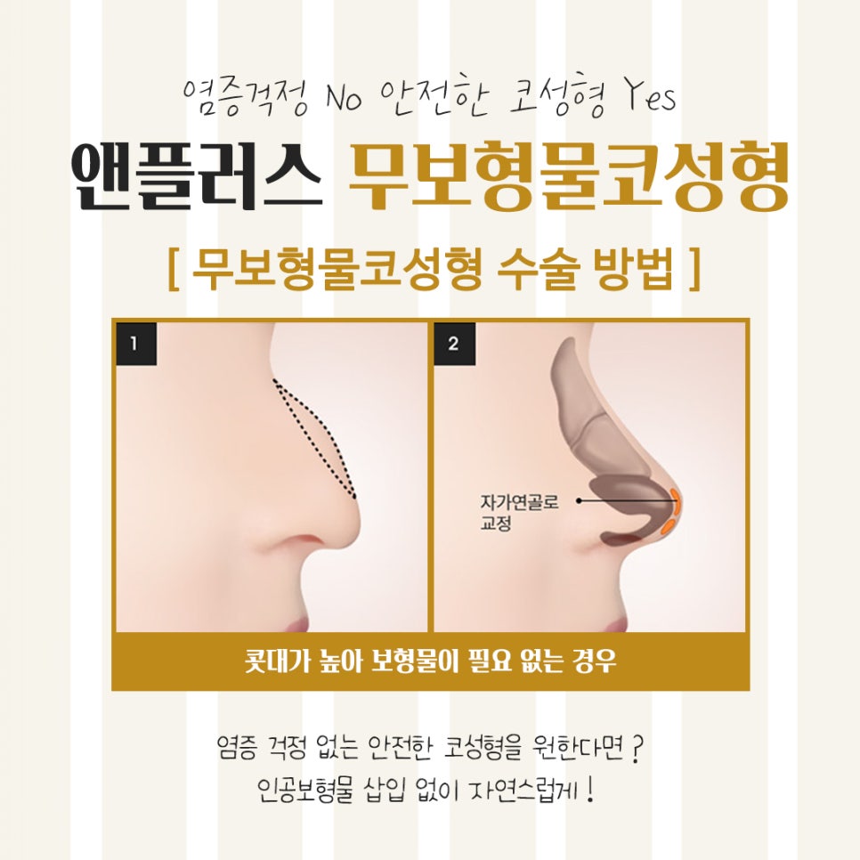 무보형물코수술후기 다양한 내용을 알아보고 관련 이미지 8