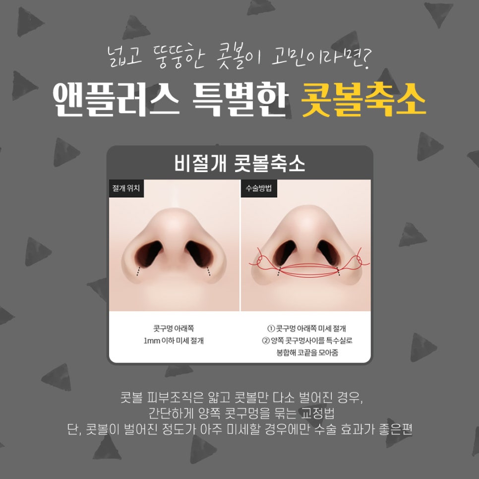 콧볼축소후기_넓은콧볼 고민해결 관련 이미지 6