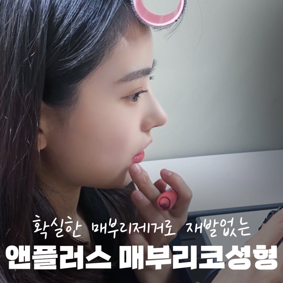 매부리코수술후기_완벽한 매부리제거로 깔끔하게 관련 이미지 3