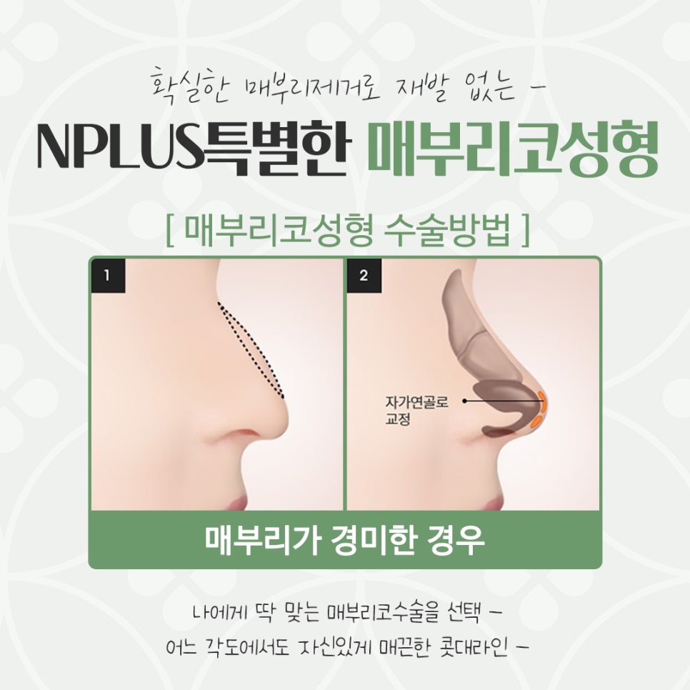 Hump Nose Surgery Review: Check Carefully image 10