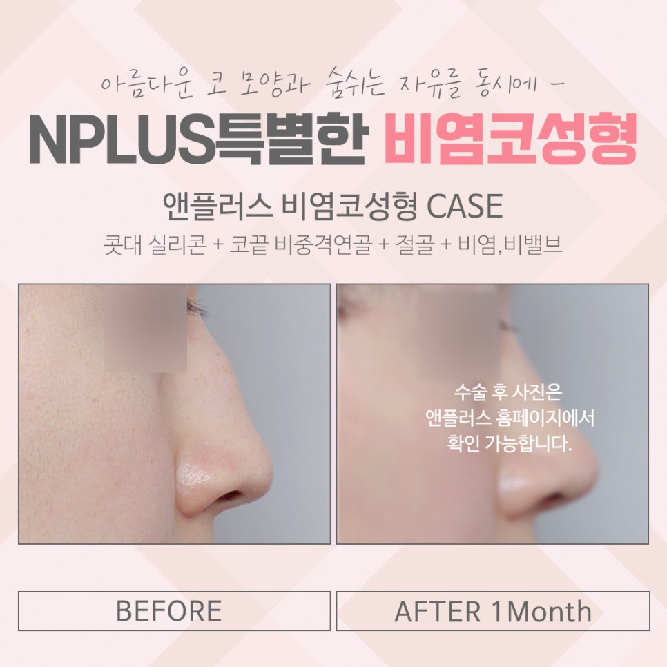 비염코수술후기 확실한 진단으로 관련 이미지 14