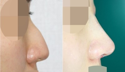 매부리코(절골+무보형물+코끝+비염+비밸브수술) 관련 이미지 1