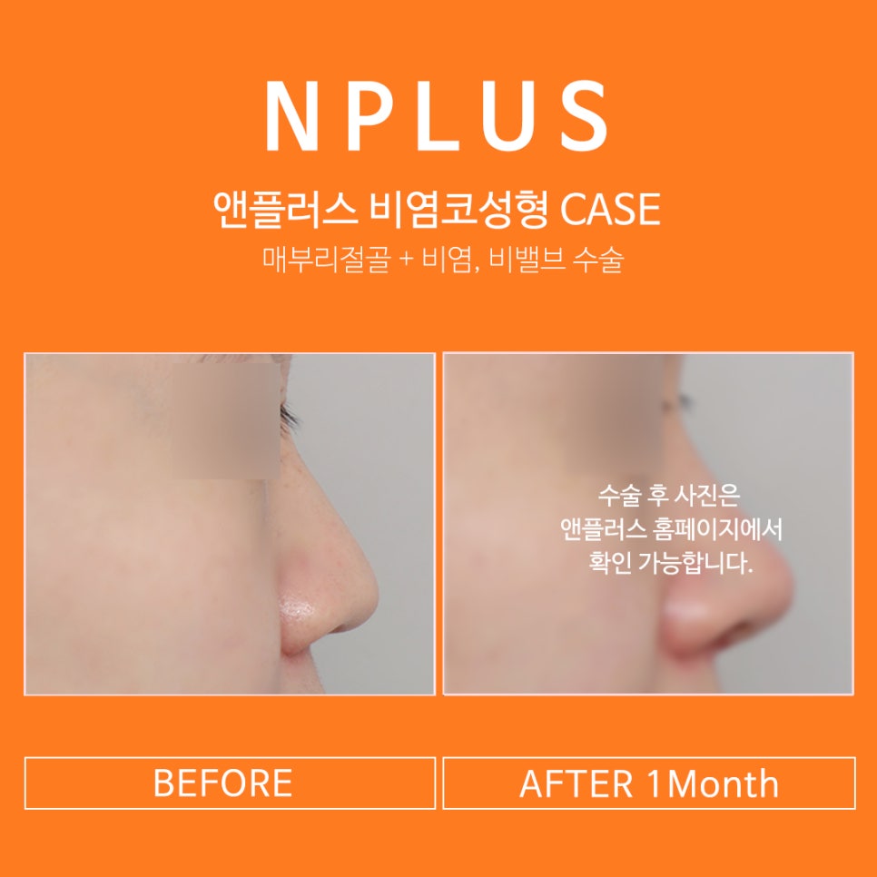 Breathing Freedom and a Beautiful Nose Shape at A+ Clinic at the Same Time image 10