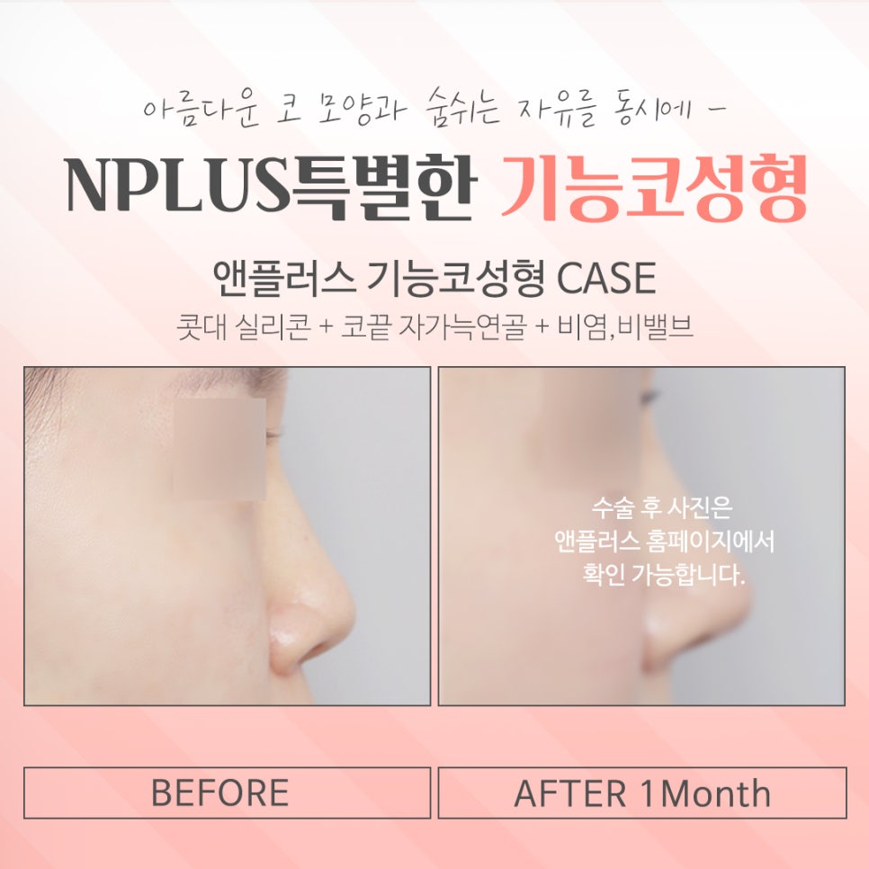 기능코성형전후를 찾아보고 관련 이미지 15