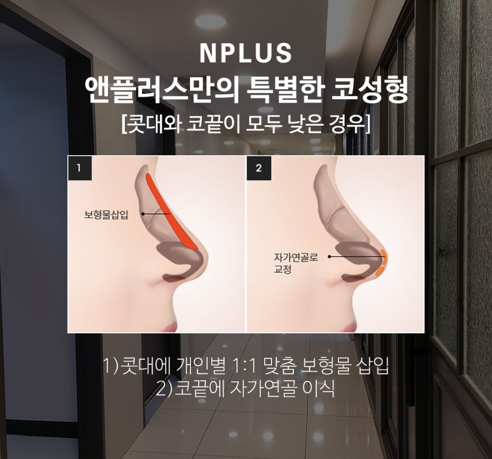 자가늑연골코성형 으로 코재수술 고민 해결 관련 이미지 3