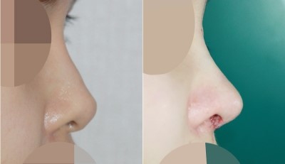 앤플러스 코재수술 (보형물 교체) 관련 이미지 1