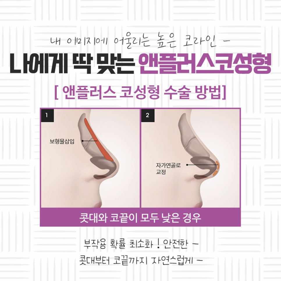자가연골코성형을 통해 자연스럽고 예쁜 라인으로 관련 이미지 8