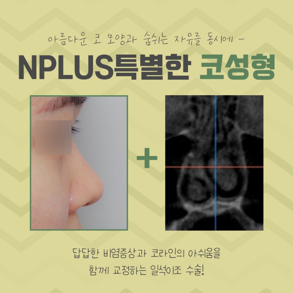 코성형전후 꼼꼼하게 비교하고 결정 관련 이미지 4