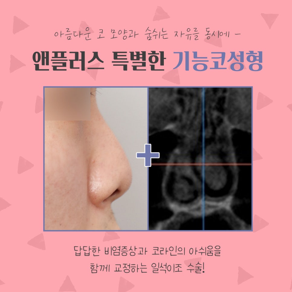 코수술후기 비중격만곡증까지 확인하여 관련 이미지 5